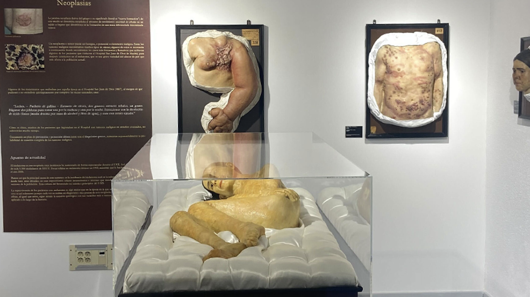 Medical wax museum in Spain showcasing 19th-century diseases is set to close
